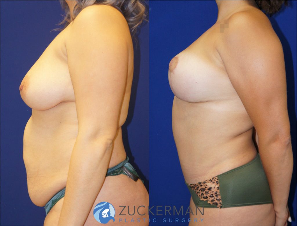 Mommy makeover by Dr. Zuckerman. Female patient, 4 months postop. Vertical breast lift (mastopexy) and tummy tuck (abdominoplasty) with liposuction of abdomen and flanks. left profile