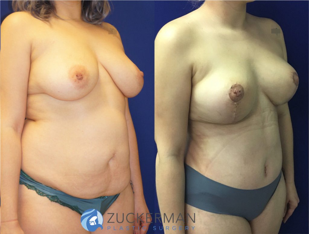 Mommy makeover by Dr. Zuckerman. Female patient, 4 months postop. Vertical breast lift (mastopexy) and tummy tuck (abdominoplasty) with liposuction of abdomen and flanks. right oblique