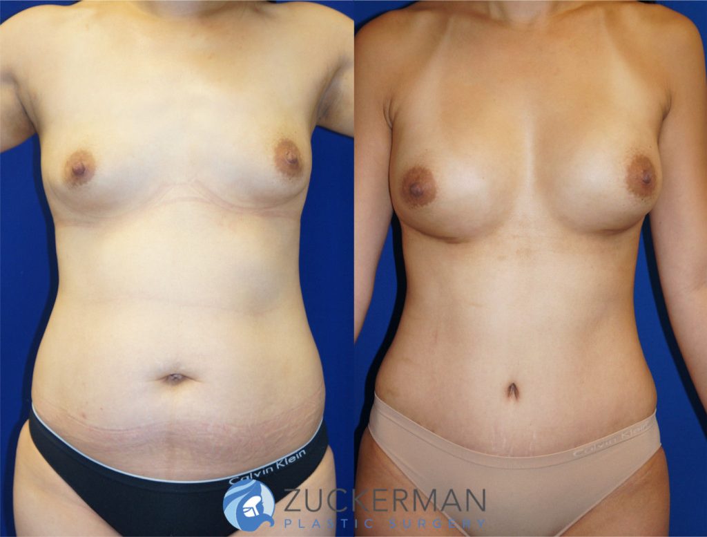 Mommy makeover by Dr. Zuckerman. Female patient, 2 months postop. Breast augmentation with 400cc Mentor Round silicone implant and tummy tuck (abdominoplasty) with liposuction of abdomen and flanks. frontal