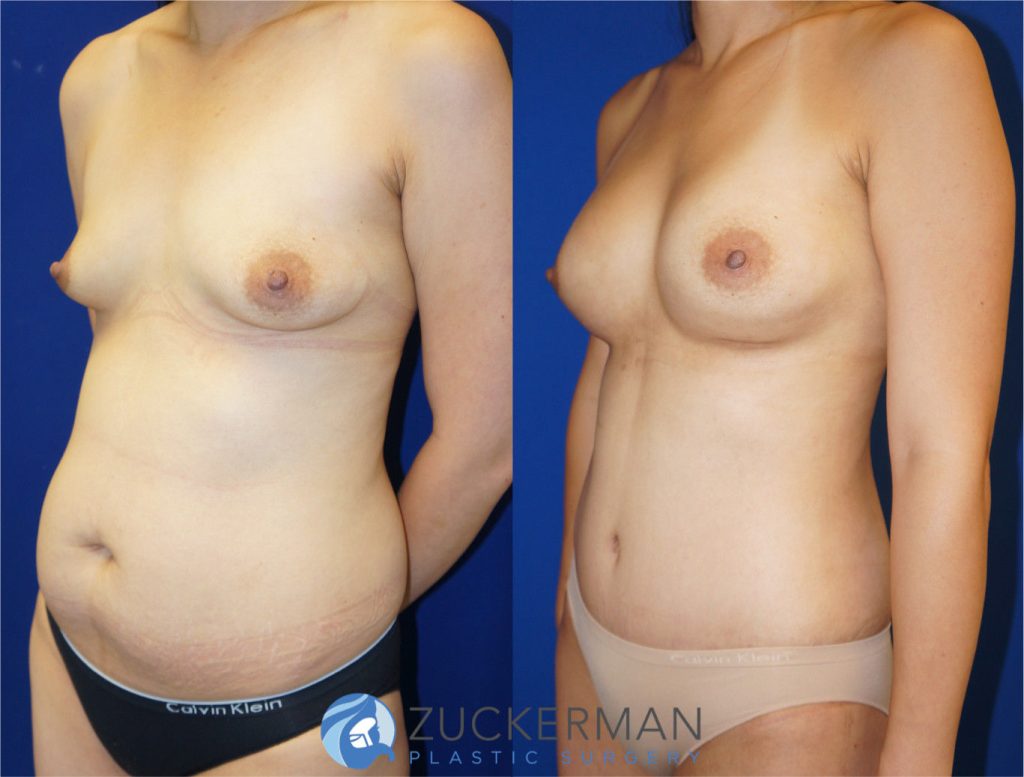 Mommy makeover by Dr. Zuckerman. Female patient, 2 months postop. Breast augmentation with 400cc Mentor Round silicone implant and tummy tuck (abdominoplasty) with liposuction of abdomen and flanks. left oblique