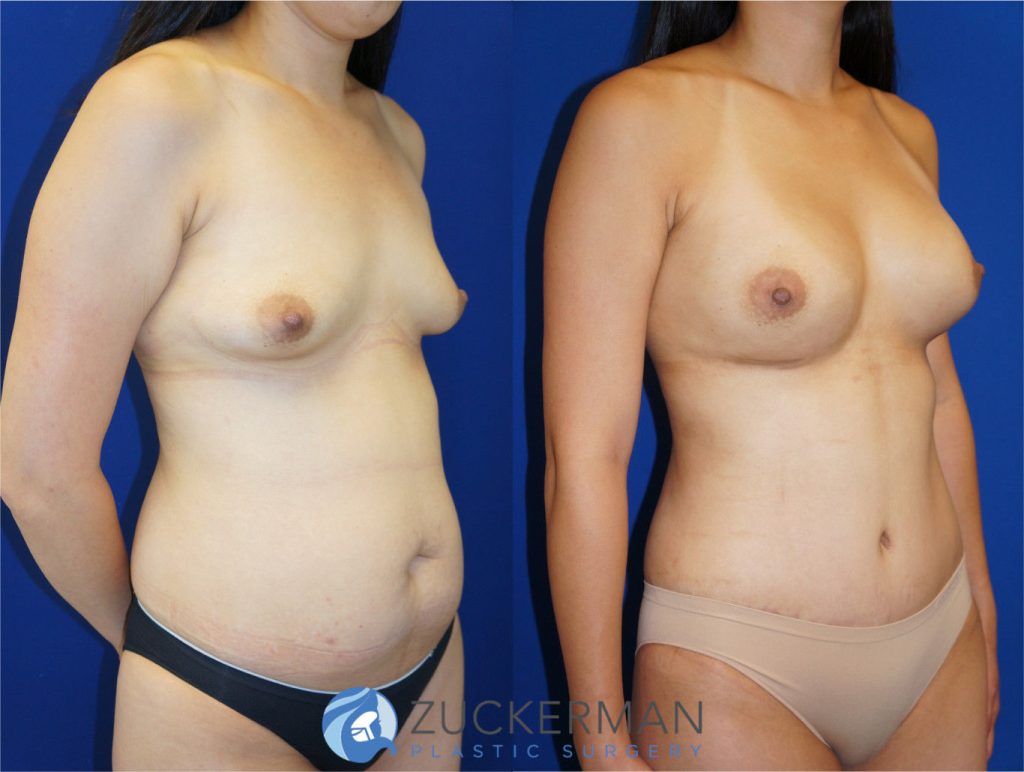 Mommy makeover by Dr. Zuckerman. Female patient, 2 months postop. Breast augmentation with 400cc Mentor Round silicone implant and tummy tuck (abdominoplasty) with liposuction of abdomen and flanks. right oblique