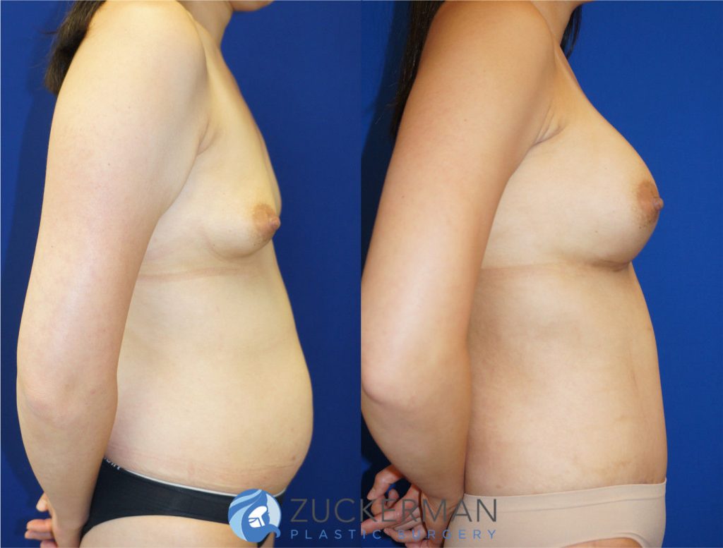 Mommy makeover by Dr. Zuckerman. Female patient, 2 months postop. Breast augmentation with 400cc Mentor Round silicone implant and tummy tuck (abdominoplasty) with liposuction of abdomen and flanks. right profile