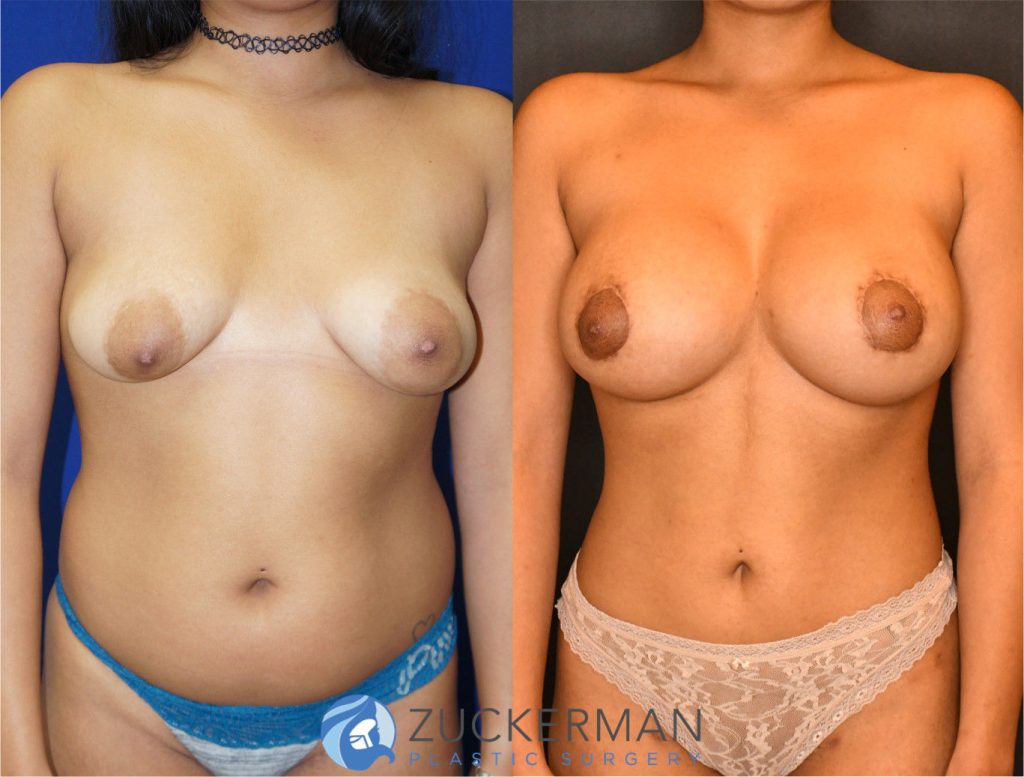 Mommy makeover by Dr. Zuckerman. Female patient 6 months postop. Underwent a modified breast augmentation with periareolar mastopexy with radial scoring to widen the base of the breast in addition to placement of silicone 400cc implants subglandular. This is a more complex surgical technique than a typical primary breast augmentation. Liposuction of abdomen and flanks also performed. Fat grafting to the buttocks also performed (not pictured). frontal