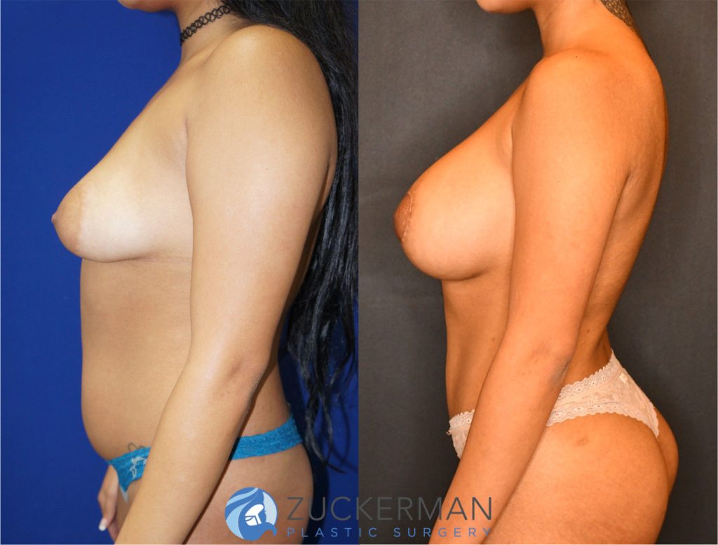 Mommy makeover by Dr. Zuckerman. Female patient 6 months postop. Underwent a modified breast augmentation with periareolar mastopexy with radial scoring to widen the base of the breast in addition to placement of silicone 400cc implants subglandular. This is a more complex surgical technique than a typical primary breast augmentation. Liposuction of abdomen and flanks also performed. Fat grafting to the buttocks also performed (not pictured). left profile