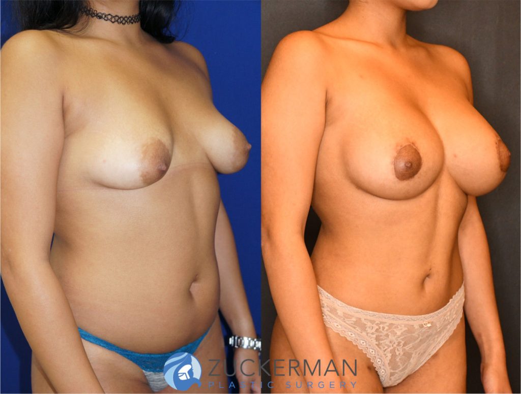 Mommy makeover by Dr. Zuckerman. Female patient 6 months postop. Underwent a modified breast augmentation with periareolar mastopexy with radial scoring to widen the base of the breast in addition to placement of silicone 400cc implants subglandular. This is a more complex surgical technique than a typical primary breast augmentation. Liposuction of abdomen and flanks also performed. Fat grafting to the buttocks also performed (not pictured). right oblique