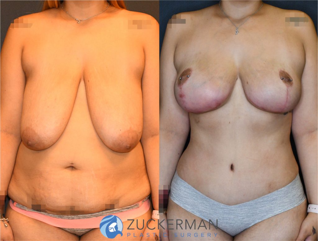 Mommy makeover by Dr. Zuckerman. Female patient 3 months postop. Wise pattern breast lift (mastopexy) and tummy tuck (abdominoplasty) with liposuction of abdomen and flanks. frontal