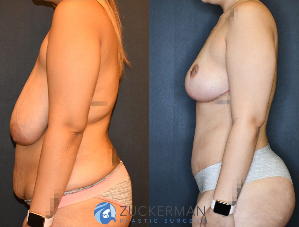 Mommy makeover by Dr. Zuckerman. Female patient 3 months postop. Wise pattern breast lift (mastopexy) and tummy tuck (abdominoplasty) with liposuction of abdomen and flanks. left profile