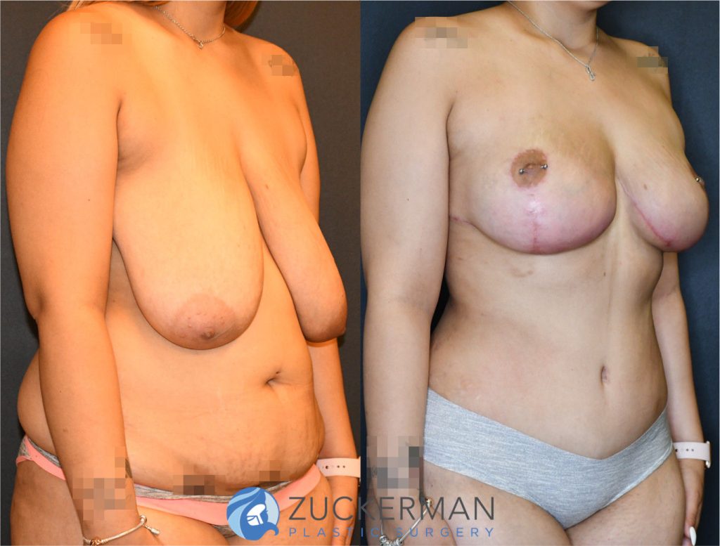 Mommy makeover by Dr. Zuckerman. Female patient 3 months postop. Wise pattern breast lift (mastopexy) and tummy tuck (abdominoplasty) with liposuction of abdomen and flanks. right oblique