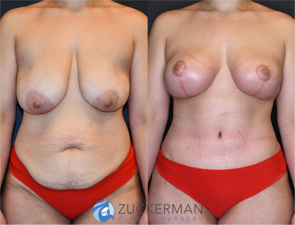 Mommy makeover or post weight loss surgery (body contouring) by Dr. Zuckerman. Female patient 1 months postop. Patient had lost 100lbs prior to surgery. Vertical breast lift (mastopexy) and tummy tuck (abdominoplasty) with liposuction of abdomen and flanks. frontal