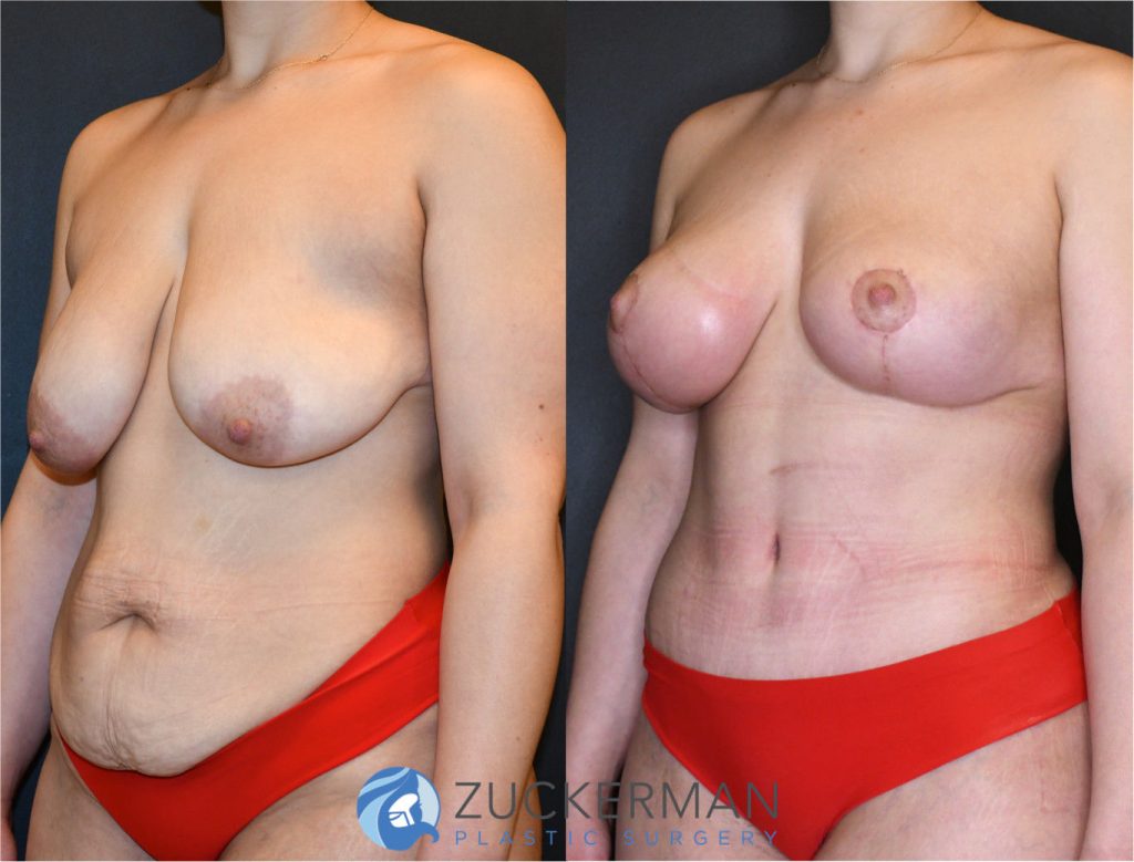 Mommy makeover or post weight loss surgery (body contouring) by Dr. Zuckerman. Female patient 1 months postop. Patient had lost 100lbs prior to surgery. Vertical breast lift (mastopexy) and tummy tuck (abdominoplasty) with liposuction of abdomen and flanks. left oblique