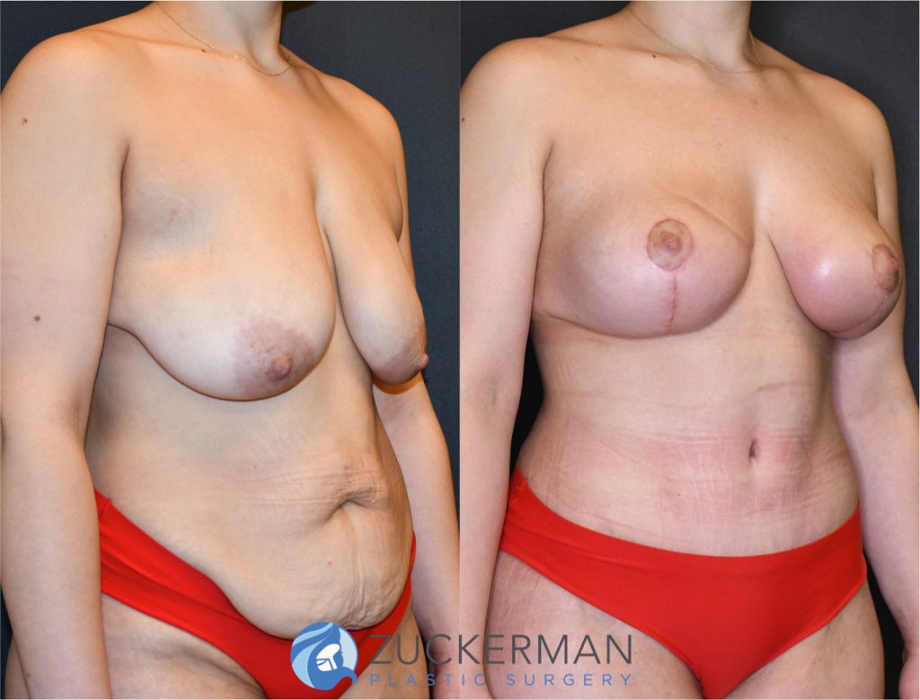 Mommy makeover or post weight loss surgery (body contouring) by Dr. Zuckerman. Female patient 1 months postop. Patient had lost 100lbs prior to surgery. Vertical breast lift (mastopexy) and tummy tuck (abdominoplasty) with liposuction of abdomen and flanks. right oblique