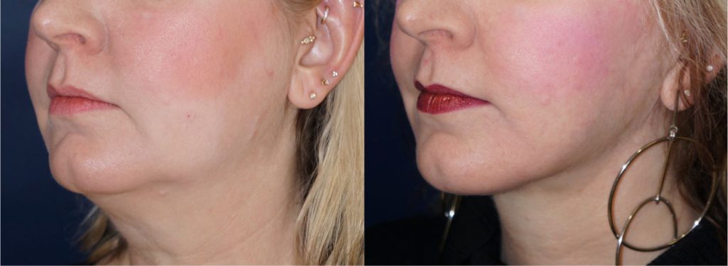 Neck lift by Dr. Zuckerman. Patient, female, 1 year postop. Patient underwent liposuction of the neck and a full facelift (not pictured). left oblique