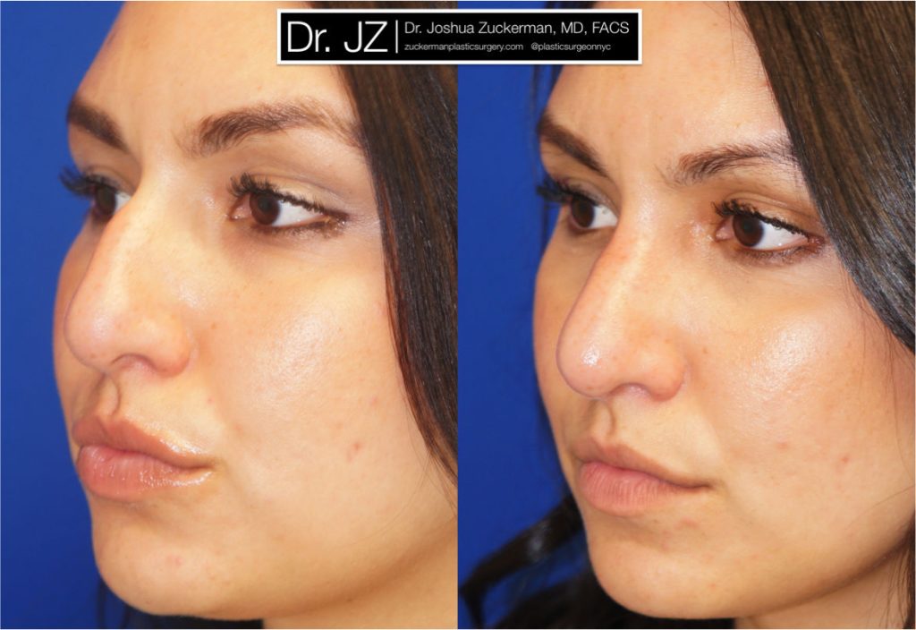 Rhinoplasty by Dr. Zuckerman. Patient, female, 2 months postop. Dorsal hump reduction. left oblique