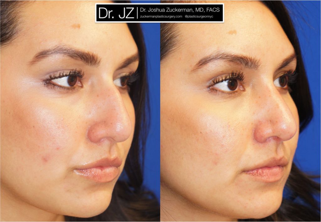 Rhinoplasty by Dr. Zuckerman. Patient, female, 2 months postop. Dorsal hump reduction. right oblique