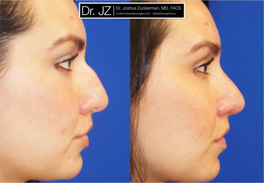 Rhinoplasty by Dr. Zuckerman. Patient, female, 2 months postop. Dorsal hump reduction. right profile