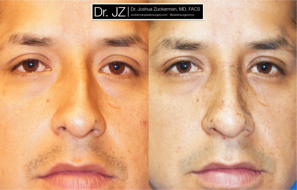 Rhinoplasty by Dr. Zuckerman. Patient, male, 1.5 months postop. Dorsal hump reduction, nasal bony asymmetry corrected. frontal