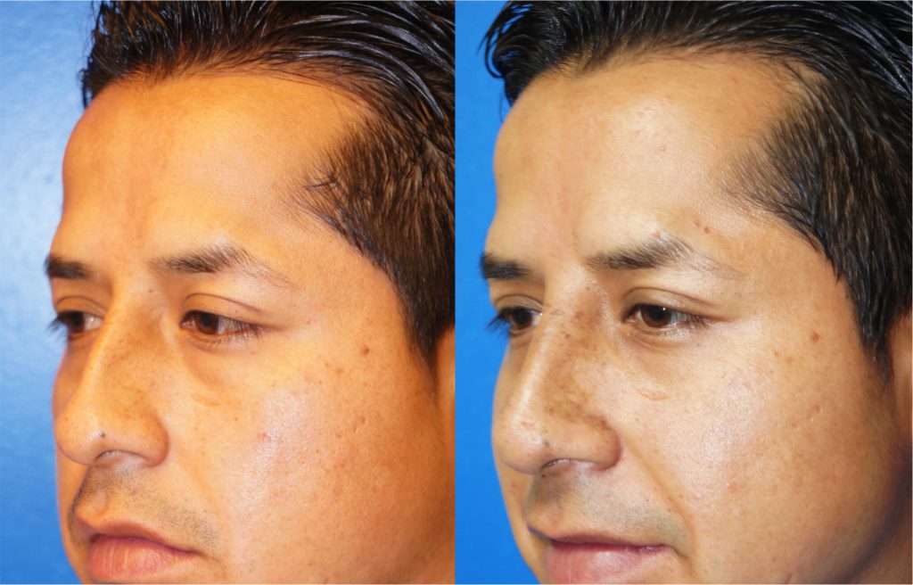 Rhinoplasty by Dr. Zuckerman. Patient, male, 1.5 months postop. Dorsal hump reduction, nasal bony asymmetry corrected. left oblique