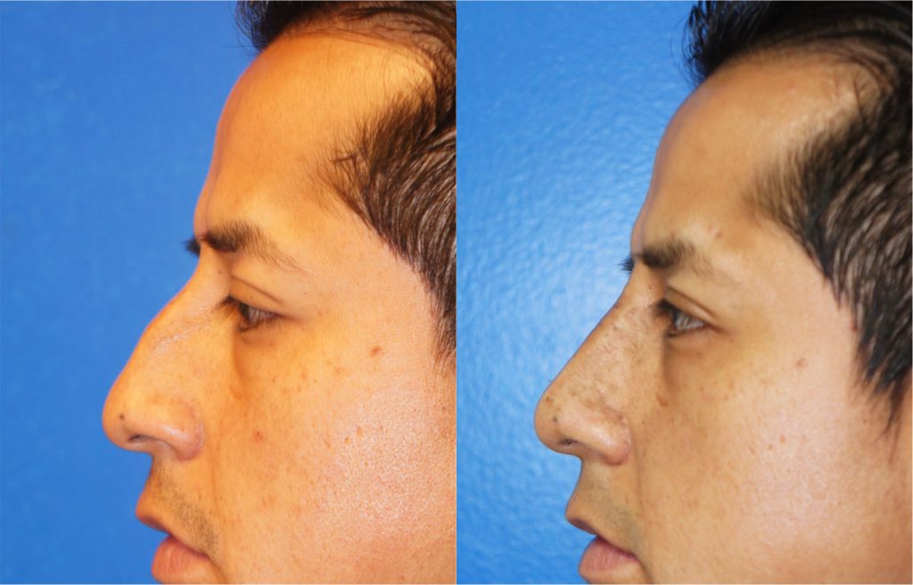 Rhinoplasty by Dr. Zuckerman. Patient, male, 1.5 months postop. Dorsal hump reduction, nasal bony asymmetry corrected. left profile