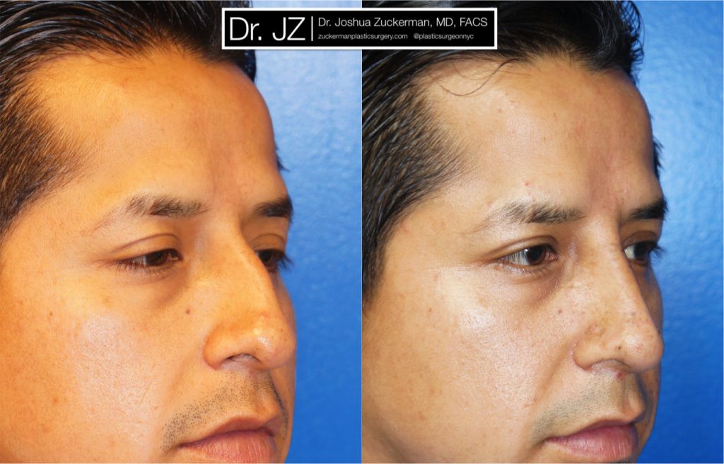 Rhinoplasty by Dr. Zuckerman. Patient, male, 1.5 months postop. Dorsal hump reduction, nasal bony asymmetry corrected. right oblique