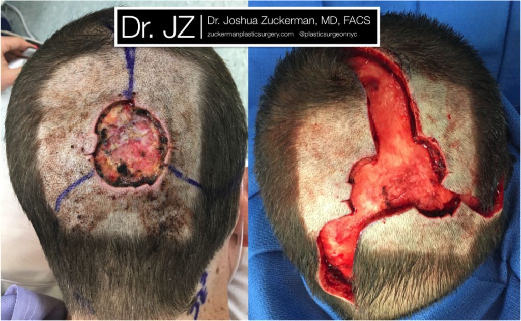 Reconstruction of a 4.5cm scalp vertex defect after Moh’s excision of basal cell carcinoma using pinwheel flaps by Dr. Zuckerman. 1 month postop.