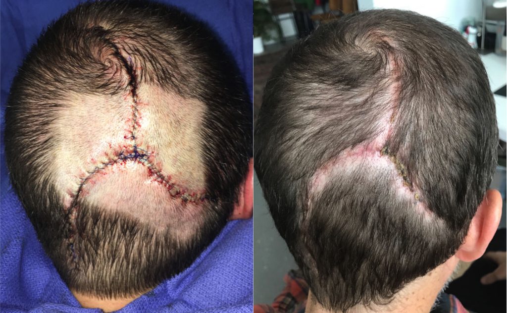 Reconstruction of a 4.5cm scalp vertex defect after Moh’s excision of basal cell carcinoma using pinwheel flaps by Dr. Zuckerman. 1 month postop.