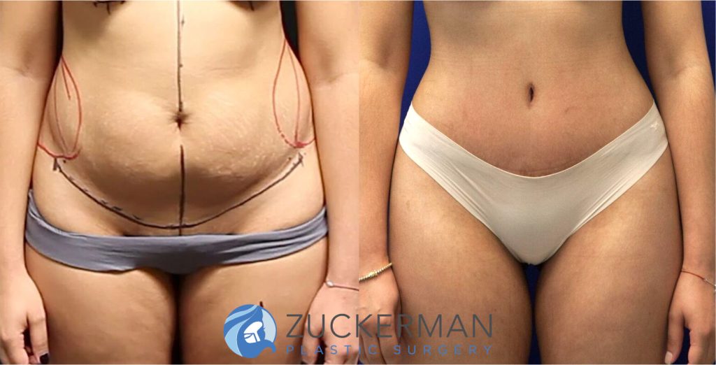 Tummy Tuck (abdominoplasty) by Dr. Zuckerman. Patient, female, 2 months postop. Liposuction of abdomen and flanks also performed. frontal