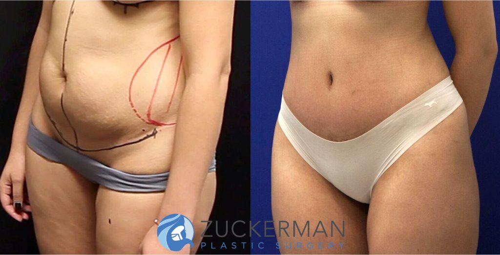 Tummy Tuck (abdominoplasty) by Dr. Zuckerman. Patient, female, 2 months postop. Liposuction of abdomen and flanks also performed. left oblique