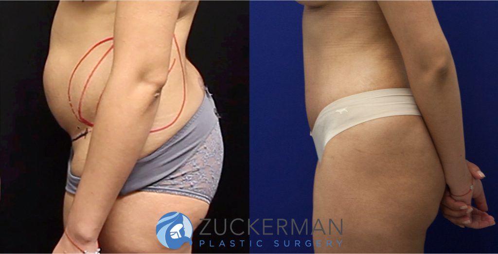 Tummy Tuck (abdominoplasty) by Dr. Zuckerman. Patient, female, 2 months postop. Liposuction of abdomen and flanks also performed. left profile