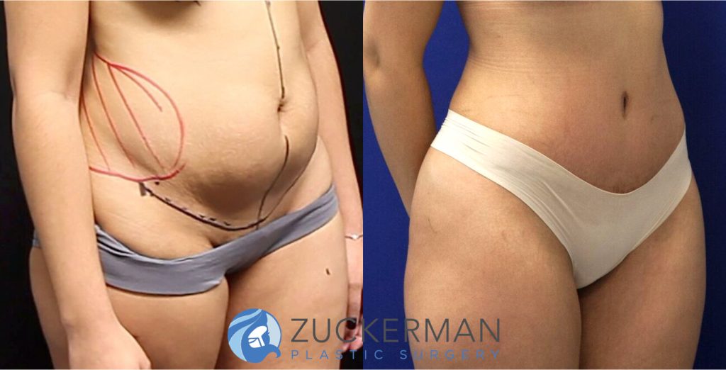 Tummy Tuck (abdominoplasty) by Dr. Zuckerman. Patient, female, 2 months postop. Liposuction of abdomen and flanks also performed. right oblique