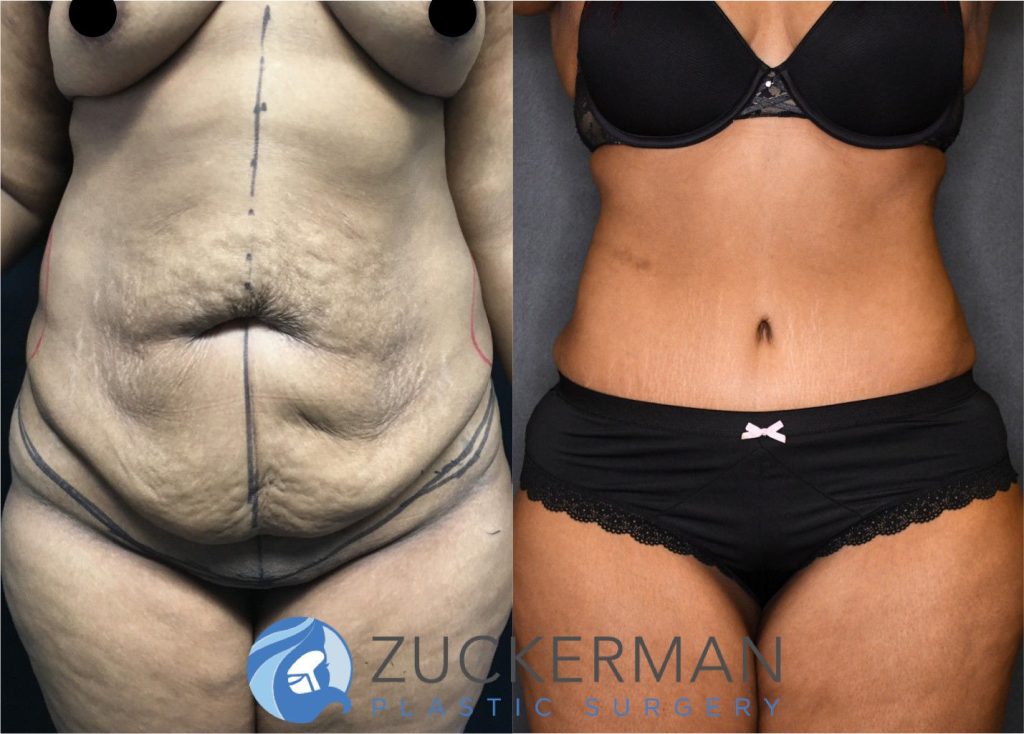 Tummy Tuck (abdominoplasty) by Dr. Zuckerman. Post weight loss patient, female, 12 months postop. Patient had lost 100lbs prior to surgery. frontal