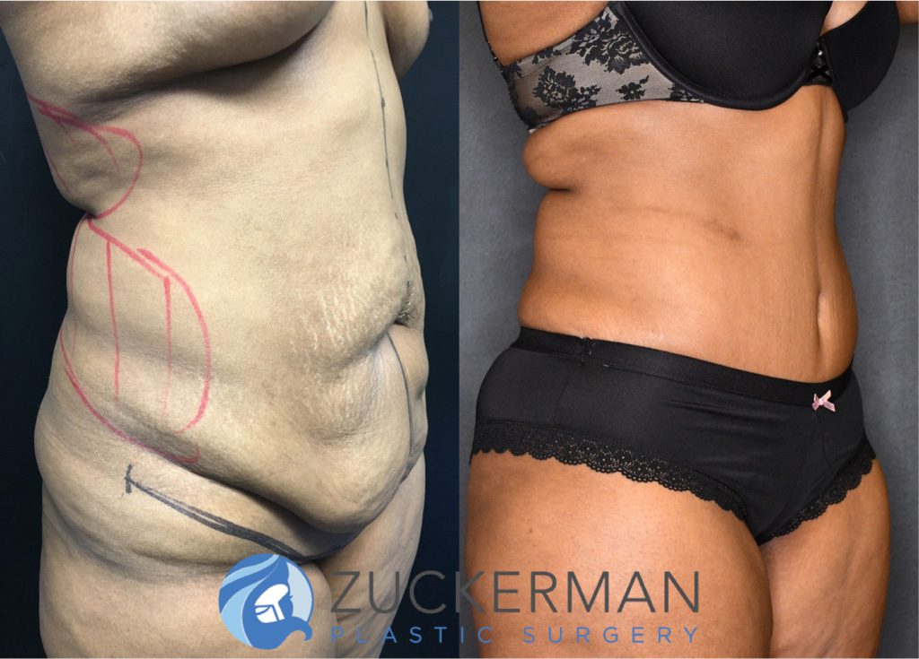 Tummy Tuck (abdominoplasty) by Dr. Zuckerman. Post weight loss patient, female, 12 months postop. Patient had lost 100lbs prior to surgery. oblique