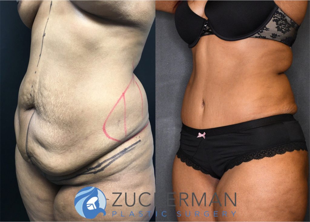 Tummy Tuck (abdominoplasty) by Dr. Zuckerman. Post weight loss patient, female, 12 months postop. Patient had lost 100lbs prior to surgery. right oblique