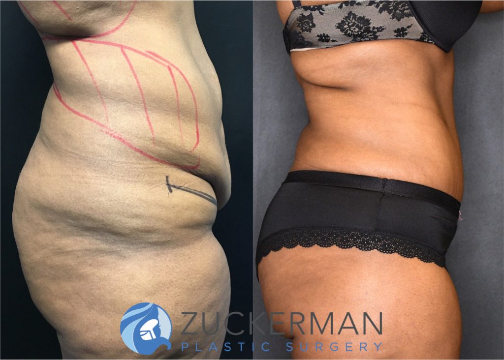 Tummy Tuck (abdominoplasty) by Dr. Zuckerman. Post weight loss patient, female, 12 months postop. Patient had lost 100lbs prior to surgery. right profile