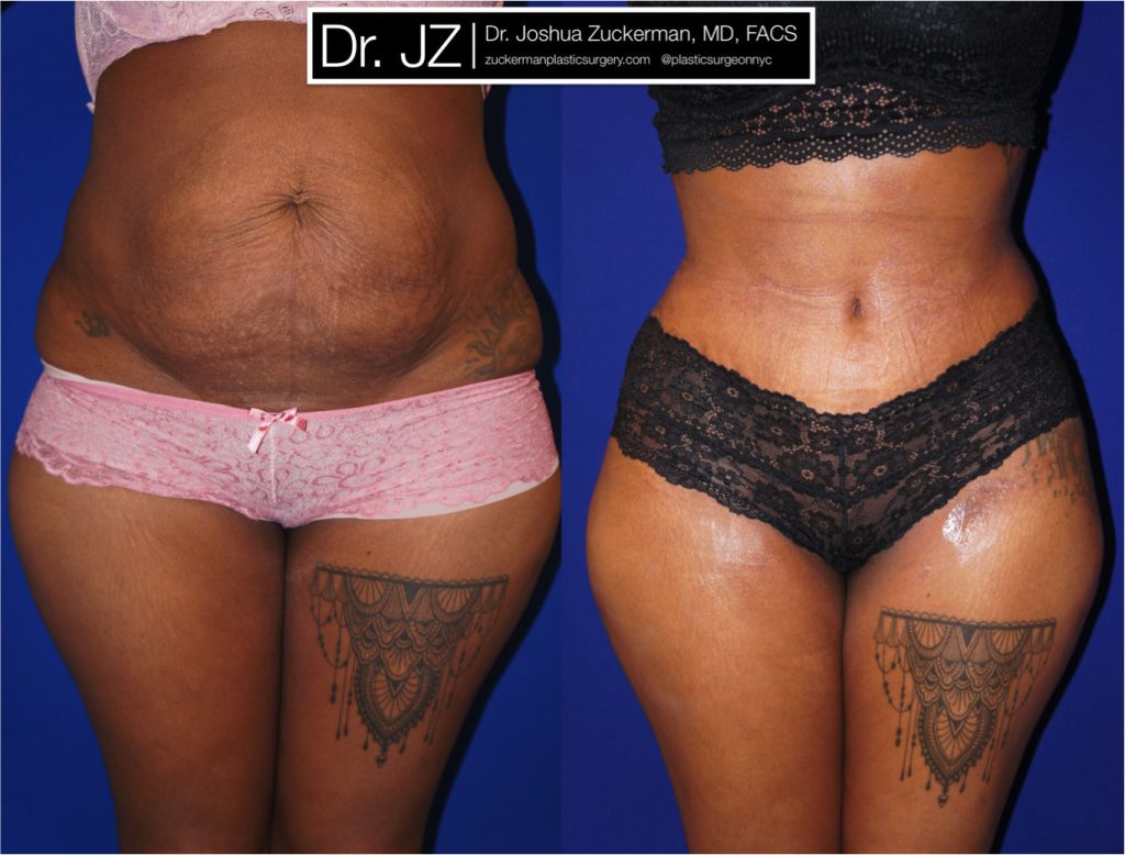 Tummy Tuck (abdominoplasty) by Dr. Zuckerman. Patient, female, 1 month postop. One liter of fat also removed via liposuction of abdomen and flanks. frontal