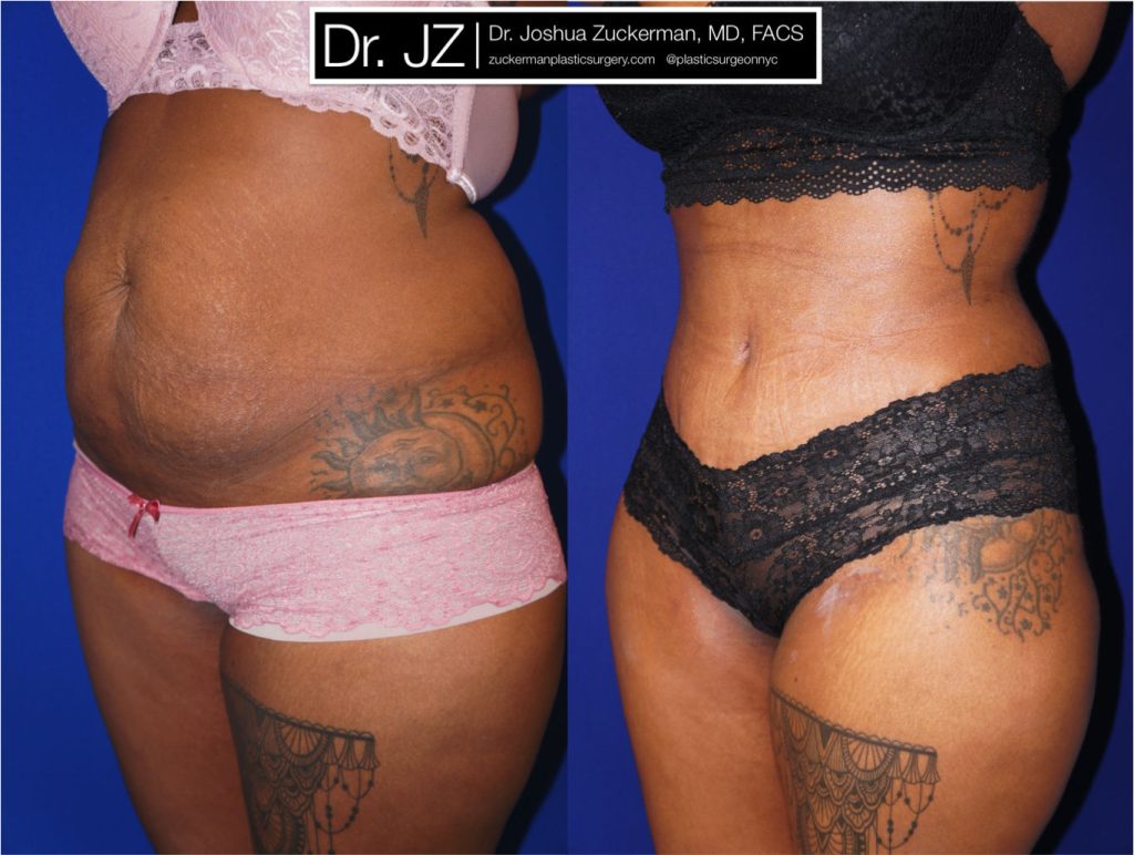 Tummy Tuck (abdominoplasty) by Dr. Zuckerman. Patient, female, 1 month postop. One liter of fat also removed via liposuction of abdomen and flanks. left oblique 1