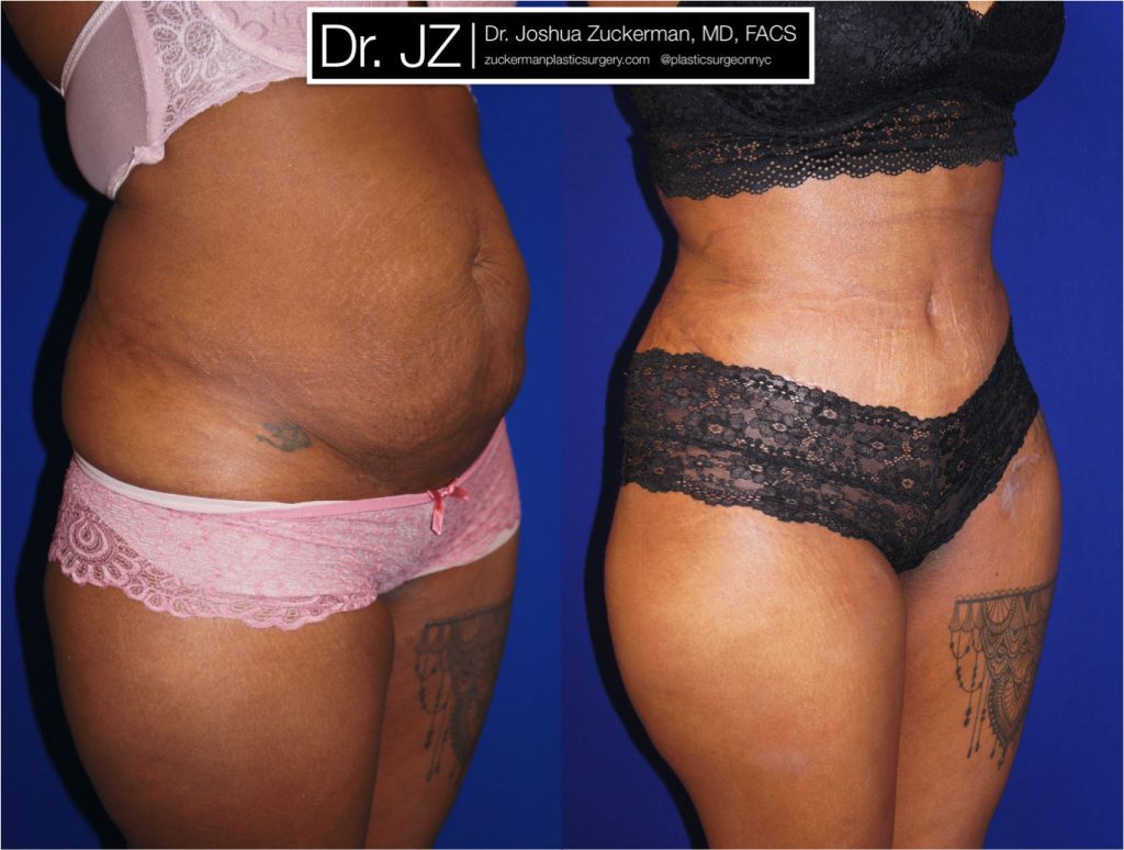 Tummy Tuck (abdominoplasty) by Dr. Zuckerman. Patient, female, 1 month postop. One liter of fat also removed via liposuction of abdomen and flanks. left oblique