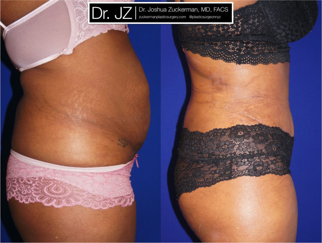 Tummy Tuck (abdominoplasty) by Dr. Zuckerman. Patient, female, 1 month postop. One liter of fat also removed via liposuction of abdomen and flanks. right profile