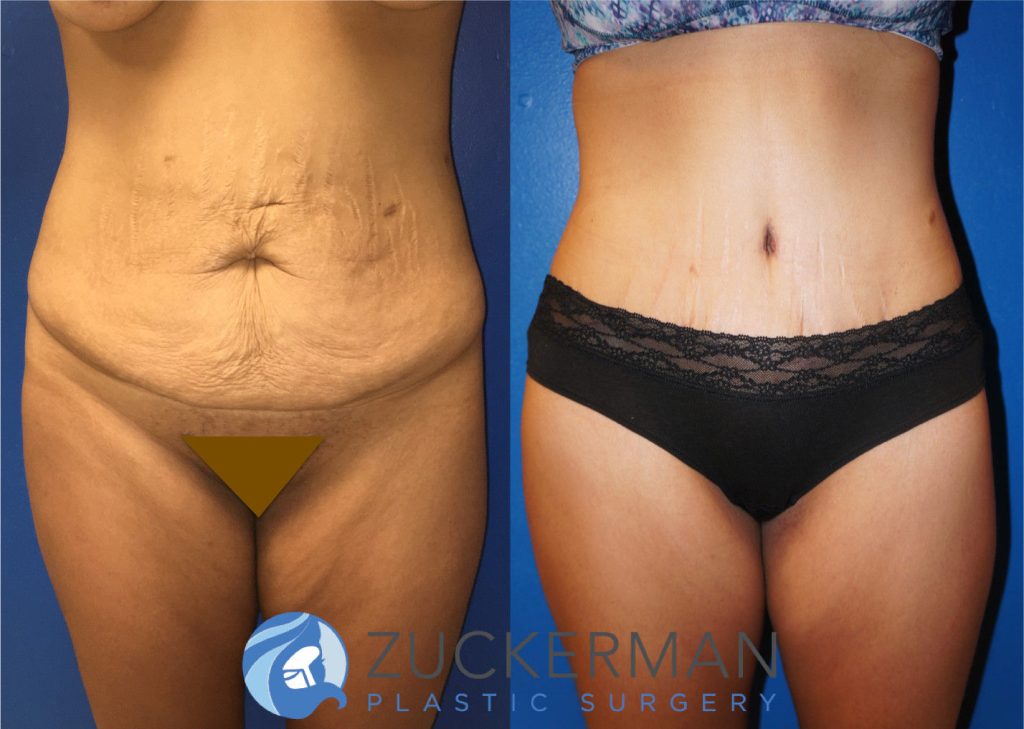 Tummy Tuck (abdominoplasty) by Dr. Zuckerman. Patient, female, 1 month postop. Liposuction of abdomen and flanks also performed. frontal