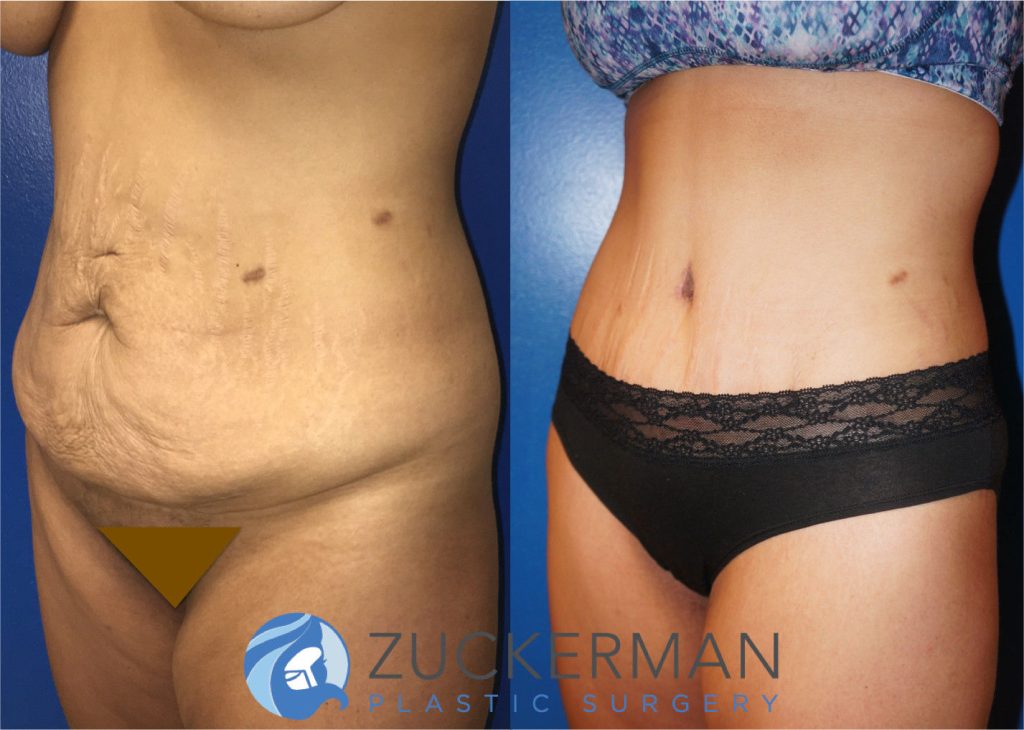 Tummy Tuck (abdominoplasty) by Dr. Zuckerman. Patient, female, 1 month postop. Liposuction of abdomen and flanks also performed. left oblique