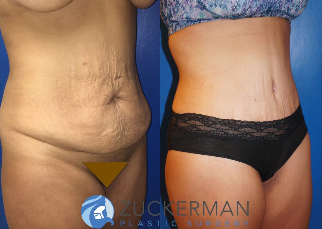 Tummy Tuck (abdominoplasty) by Dr. Zuckerman. Patient, female, 1 month postop. Liposuction of abdomen and flanks also performed. right oblique