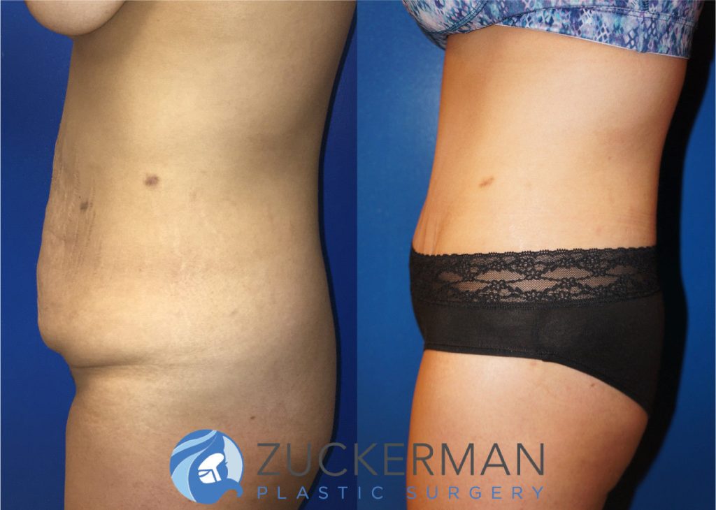 Tummy Tuck (abdominoplasty) by Dr. Zuckerman. Patient, female, 1 month postop. Liposuction of abdomen and flanks also performed. right profile