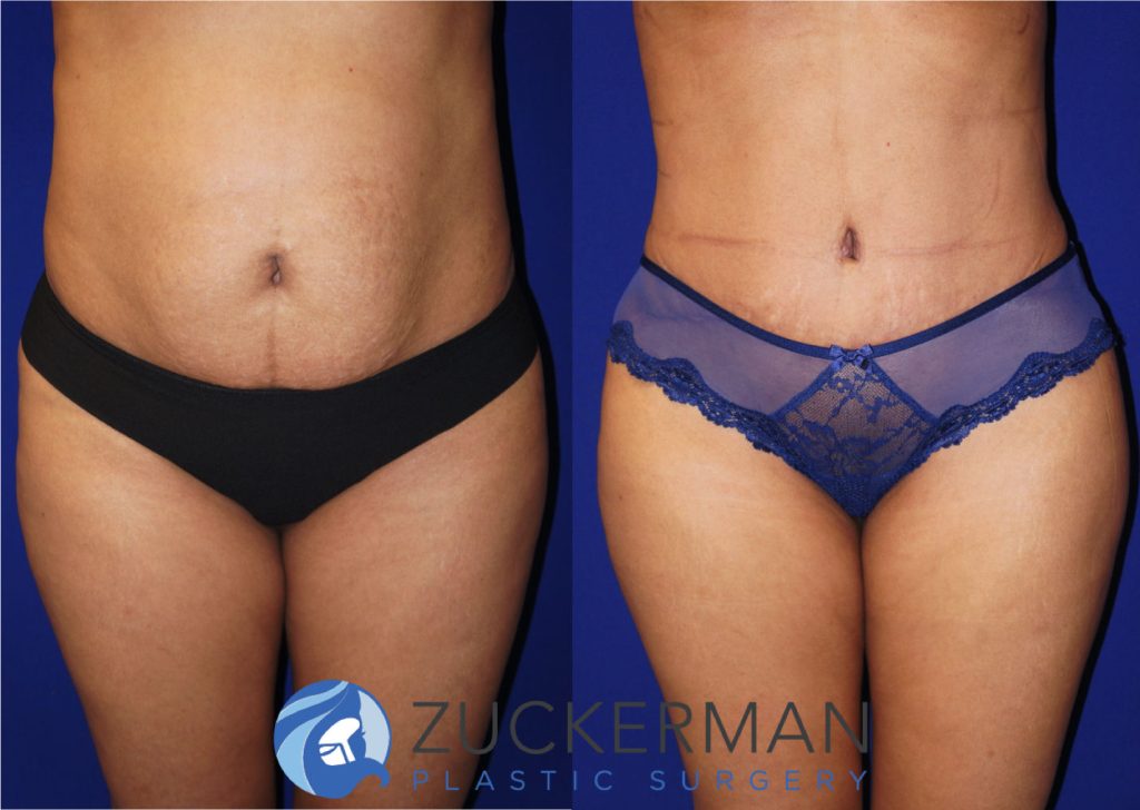 Tummy Tuck (abdominoplasty) by Dr. Zuckerman. Patient, female, 2 months postop. Liposuction of abdomen and flanks also performed. frontal