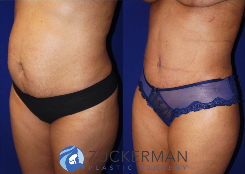 Tummy Tuck (abdominoplasty) by Dr. Zuckerman. Patient, female, 2 months postop. Liposuction of abdomen and flanks also performed. left oblique