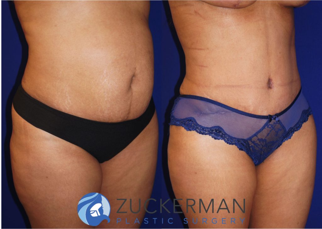 Tummy Tuck (abdominoplasty) by Dr. Zuckerman. Patient, female, 2 months postop. Liposuction of abdomen and flanks also performed. right oblique