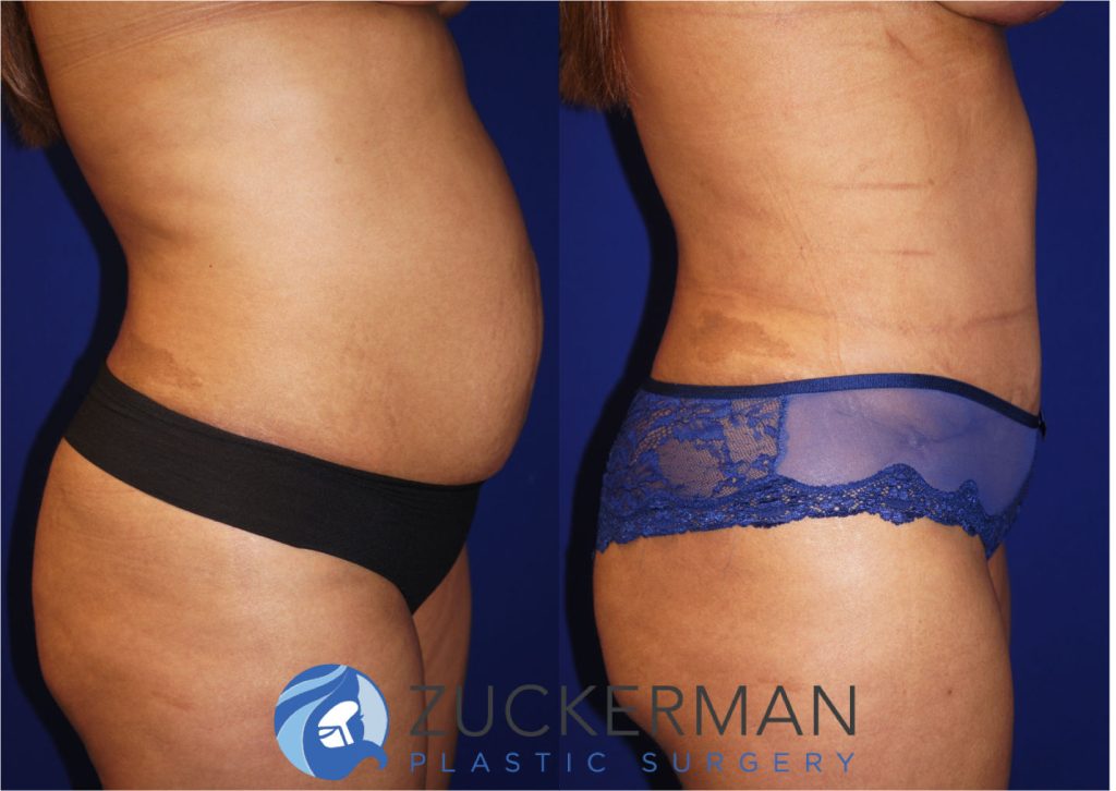 Tummy Tuck (abdominoplasty) by Dr. Zuckerman. Patient, female, 2 months postop. Liposuction of abdomen and flanks also performed. right profile