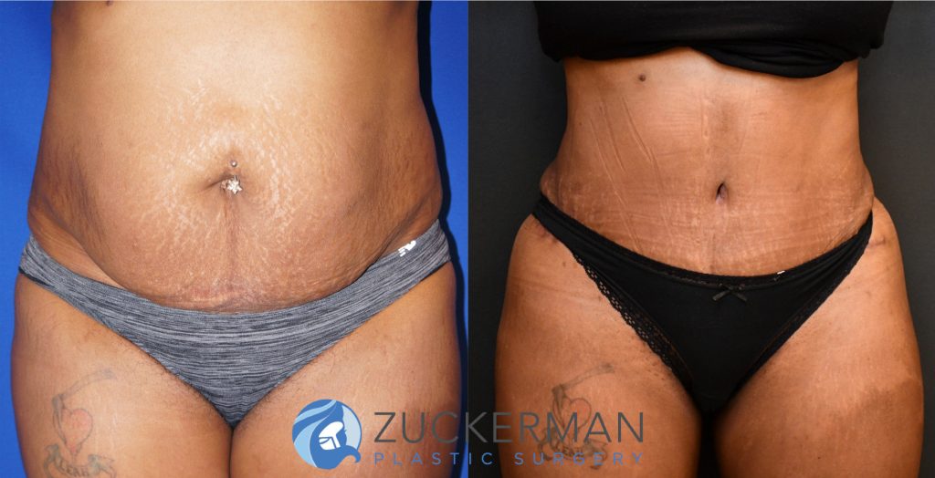 Tummy Tuck (abdominoplasty) by Dr. Zuckerman. Patient, female, 3 months postop. 3 liters of fat also removed via liposuction of abdomen and flanks. Fat grafting to the buttocks also performed. frontal