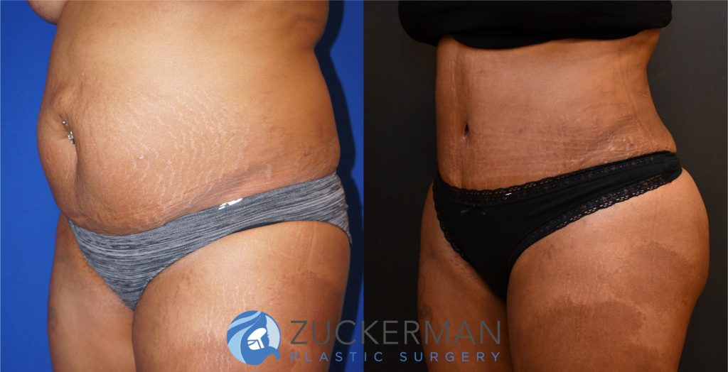 Tummy Tuck (abdominoplasty) by Dr. Zuckerman. Patient, female, 3 months postop. 3 liters of fat also removed via liposuction of abdomen and flanks. Fat grafting to the buttocks also performed. left oblique