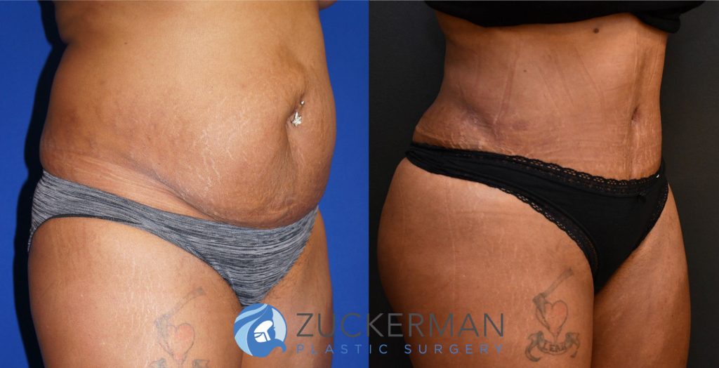 Tummy Tuck (abdominoplasty) by Dr. Zuckerman. Patient, female, 3 months postop. 3 liters of fat also removed via liposuction of abdomen and flanks. Fat grafting to the buttocks also performed. right oblique