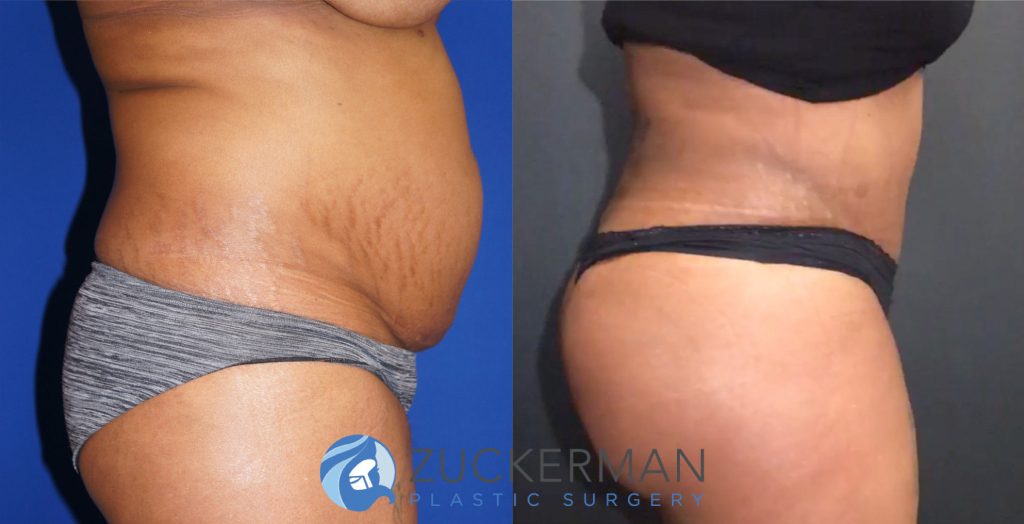 Tummy Tuck (abdominoplasty) by Dr. Zuckerman. Patient, female, 3 months postop. 3 liters of fat also removed via liposuction of abdomen and flanks. Fat grafting to the buttocks also performed. right profile