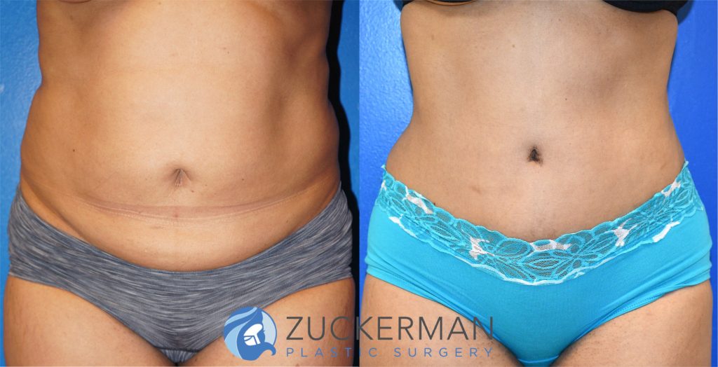 Tummy Tuck (abdominoplasty) by Dr. Zuckerman. Patient, female, 2 months postop. Liposuction of abdomen and flanks also performed. frontal